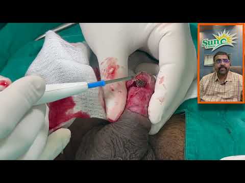 Frenuloplasty | Adhesions Release Surgery |Balanitis Complications | Skin Bridge repair by Dr.Kuber
