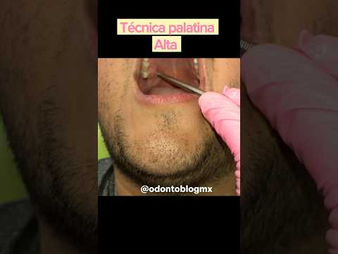 #tecnicapalatinaalta #anestesiadental #anestesiaodontologica #odontologia #odontoblogmx
