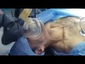 Intubation oro trachale