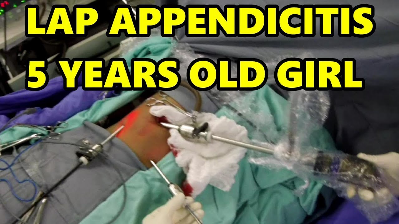 Acute Appendicitis 5 Years Old Girl Initial Stage Complete