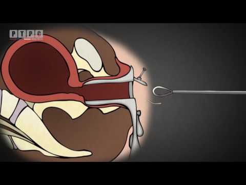 Video: Kako prirodno ublažiti kašalj (sa slikama)