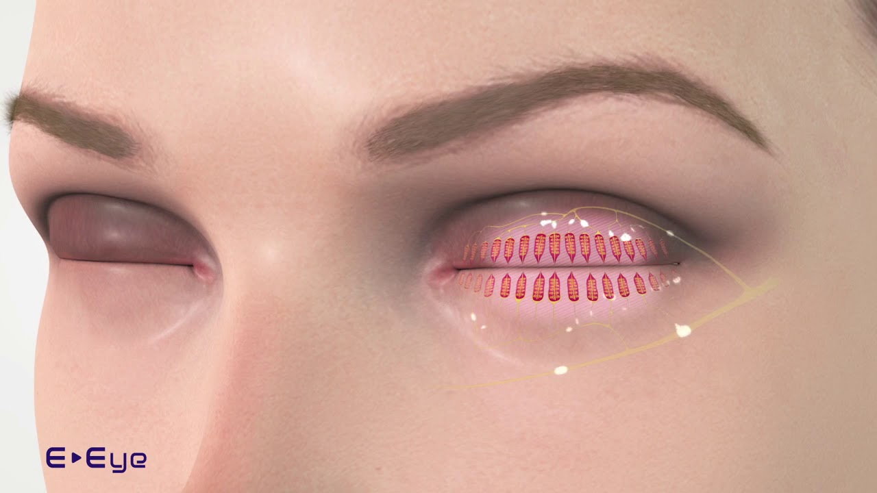 E EYE - Funktionsweise der neuen Behandlung bei Meibomdrüsen ...