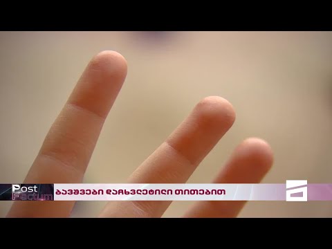 Post Factum | ბავშვები დაჩხვლეტილი თითებით