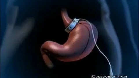 Dove fare il bendaggio gastrico a Napoli?