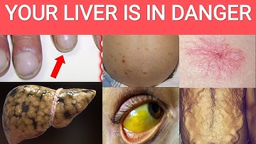 Doctor Explains 11 Skin Signs of Liver Disease / Fatty Liver / Cirrhosis