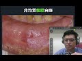 常見口腔黏膜病變:白斑、紅斑、口腔扁平苔癬的臨床與病理特徵 part 1。2025 10 20 150848