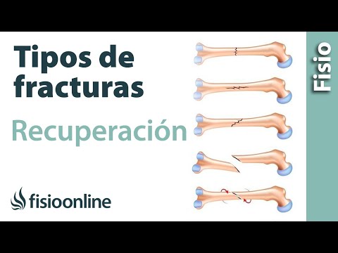 Vídeo: Fracturas óseas: Tipos, Tratamiento, Rehabilitación