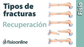 Tipos de FRACTURAS de hueso y su tratamiento y recuperación