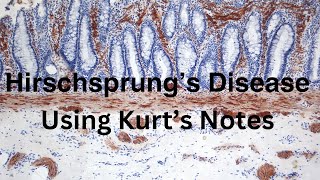 Hirschsprung’s Disease: Using Kurt’s Notes #pathagonia
