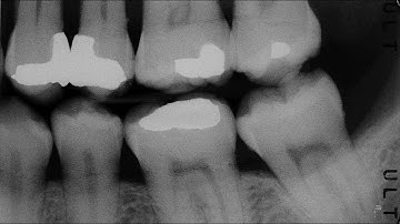 IRMER - Optimisation errors: horizontal tube angulation. L12