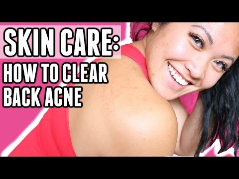 SKIN CARE: HOW TO CLEAR BACK ACNE | MY FAVOURITE PRODUCTS AND DAILY REGIMENT