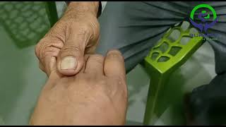 Alien limb phenomenon#Rare case#Stroke case....