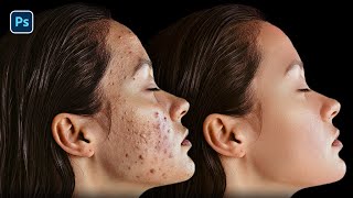 Remove pimples from face in photoshop | Easily remove acne blemishes pimples from face in photoshop screenshot 5