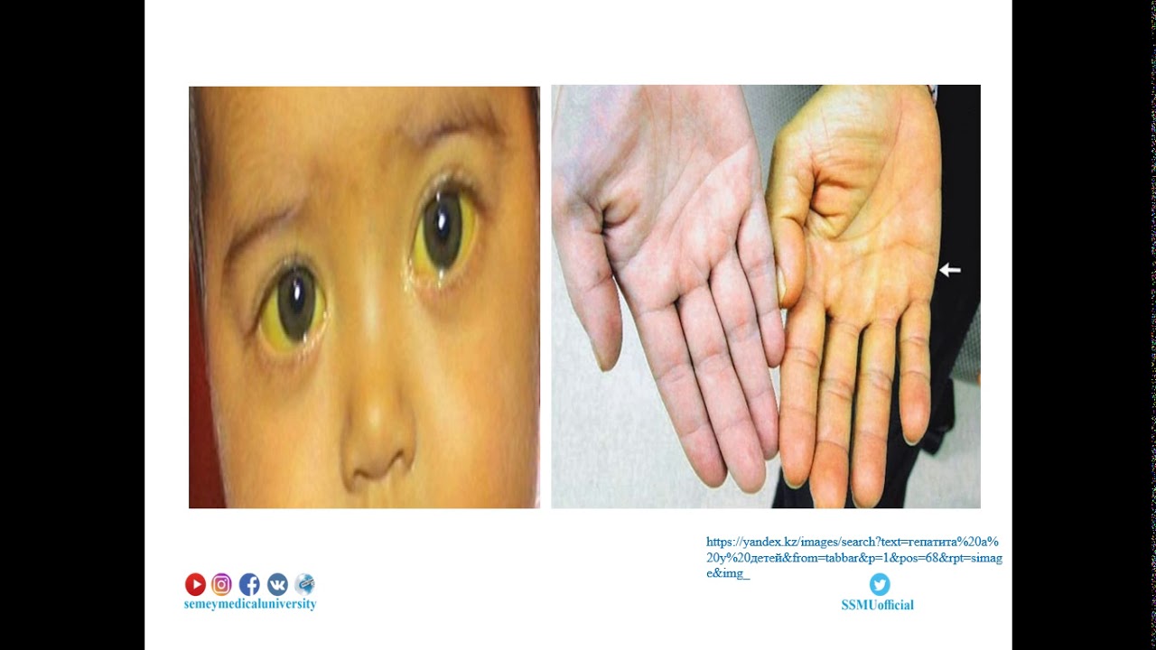 Вирусты гепатит А,Е - YouTube