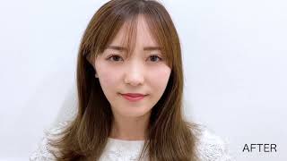 たるみが改善、糸リフトで究極のリフトアップ