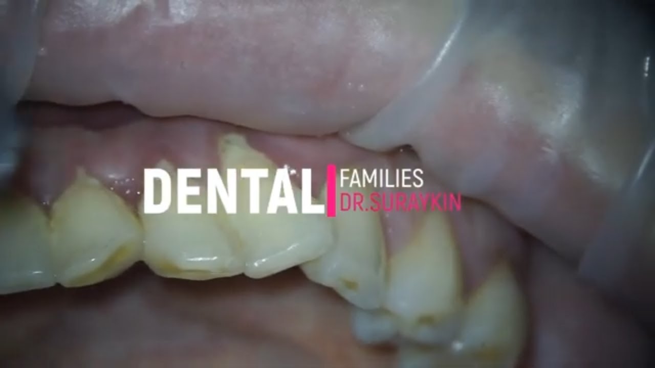 Tartar Teeth , Satisfying and relaxing tooth cleaning #dentist #teeth # ...