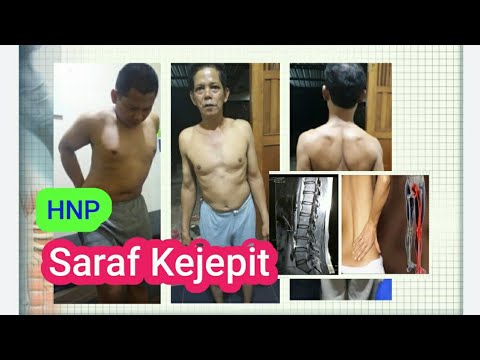 Di video ini kmi menjelaskan tentang cervical dan edukasi serta latihan latihannya. #pemeriksaan fis. 