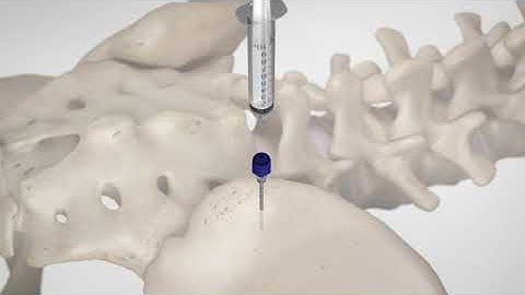 BD Trek™ Powered Bone Biopsy System: Bone Marrow Procedural Video