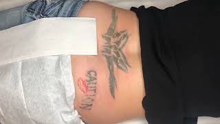 Tattoo Removal of a Tramp Stamp