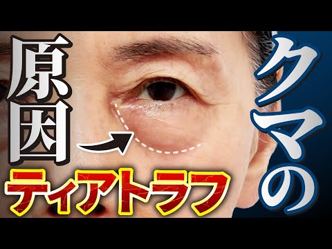 [Must-See] Treating dark circles is impossible without a tear trough! The root cause of dark circ...