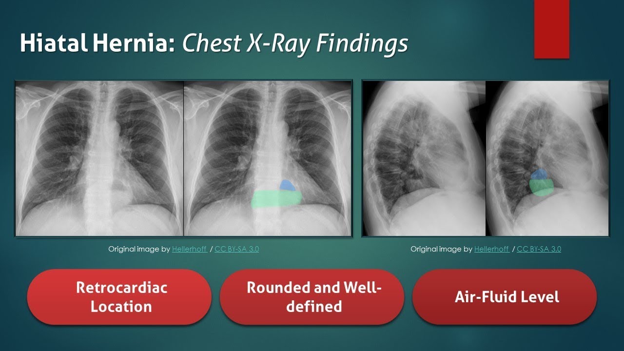 ⁣Hiatal Hernia: Explanation of Chest X-Ray Findings