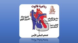 "رباعية فالوت | الأسباب الأعراض والعلاج"