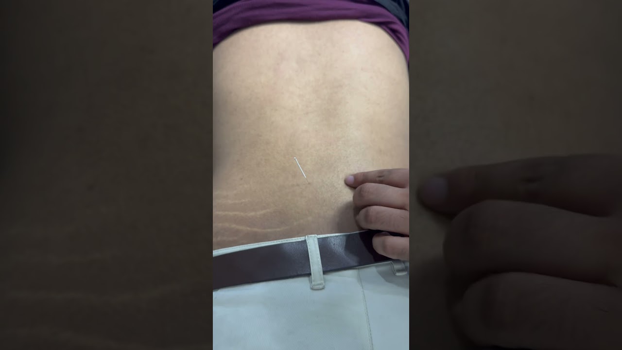 Dryneedling therapy for back pain 