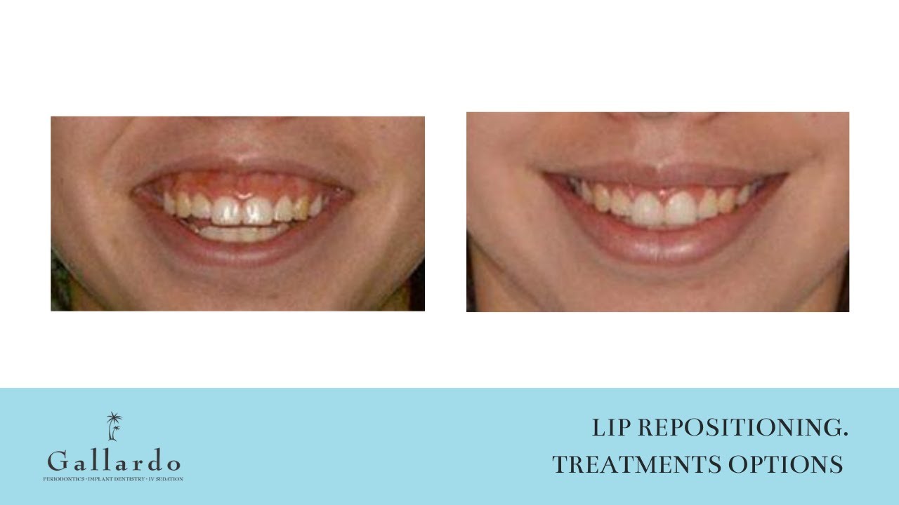 Lip Repositioning - Treatments Options - YouTube