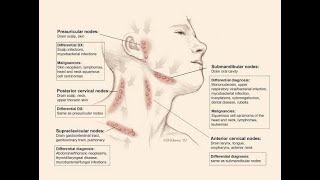 Carcinomatous (Cancer) infiltration of the supraclavicular lymph nodes (Virchow’s nodes)