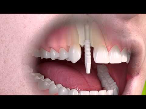 Straumann - Ceramic