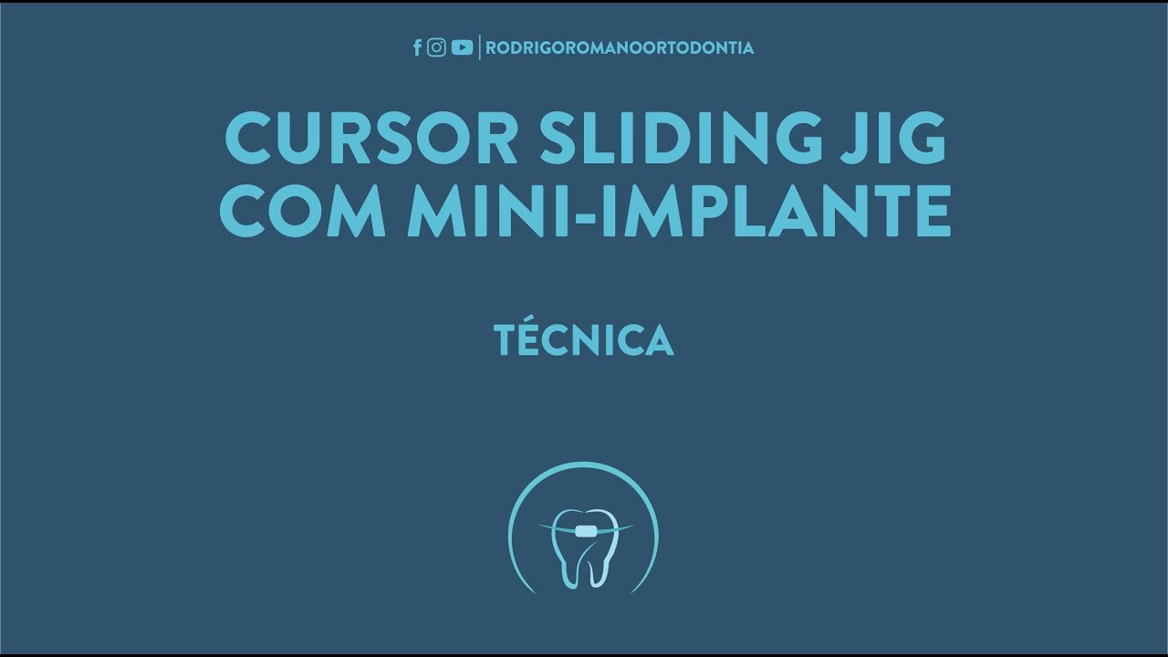 Cursor Sliding Jig com Mini-implante - Técnica Ortodôntica