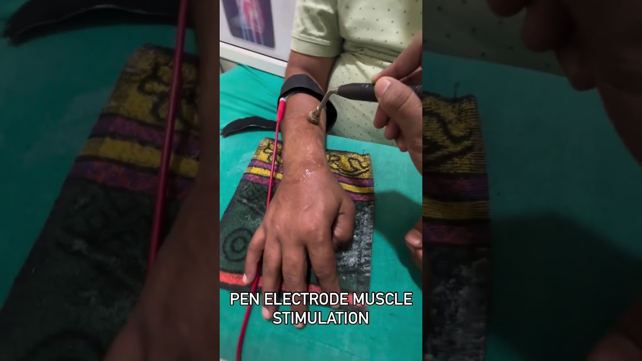 Pen Electrode muscle stimulation for Fingers and Wrist Extension