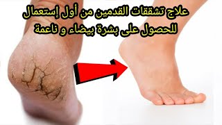 علاج تشققات القدمين من أول إستعمال | للحصول على بشرة بيضاء و ناعمة