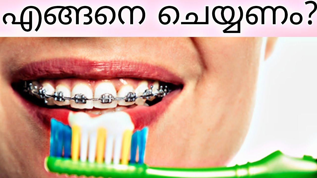 Brush with braces / pallil kambi idunnath malayalam / pallil kambi