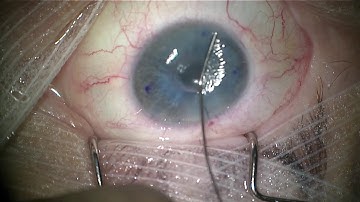 DMEK graft orientation with intraoperative OCT or slit-lamp