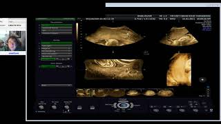 KEHAMILAN ABDOMINAL 40 minggu EXTRAUTERIN ECTOPIC (Dr Wiku Andonotopo)