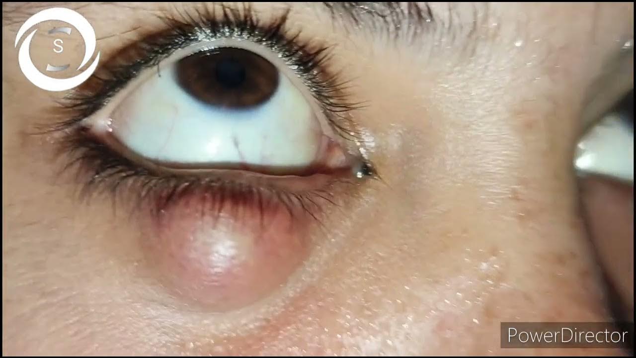 Ophthalmic Signs 394 YouTube