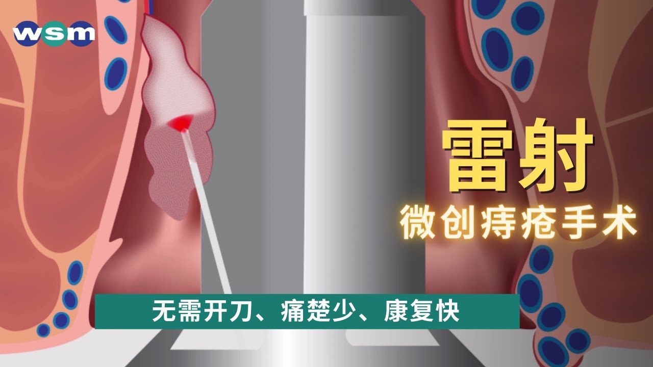 痔疮治疗马来西亚 雷射痔疮治疗不需开刀 痛楚少 康复快 轻松摆脱大便出血 肛门瘙痒 痔疮肿胀及脱出 微创痔疮手术 Youtube