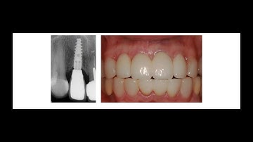 Socket Shield Technique with Dr. Thomas Nguyen