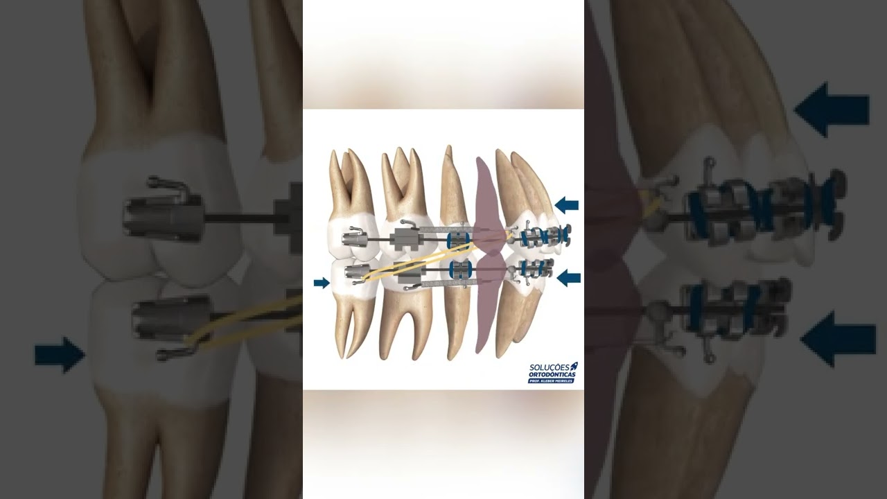 EXTRACRION | NASOLABIAL ANGLE - ORTHODONTIC TIPS 
