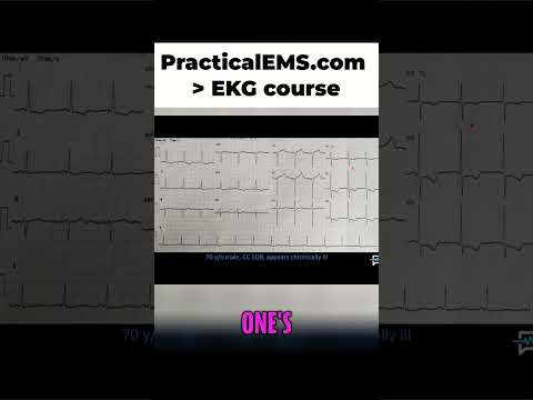 LVH Explained Diagnosing Left Ventricular Hypertrophy On ECG