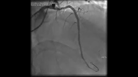 Microcatheter Tip Fracture During LAD CTO PCI: A Complication Video 10