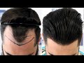 FUE Hair Transplant (2491 Grafts NW III A) By Dr Juan Couto - FUEXPERT CLINIC, Madrid, Spain