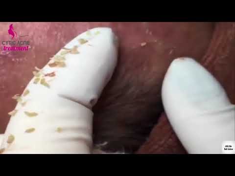 Blackheads and Acne Extraction   Cystic Acne and Zit Removal Facial Treatment At Home