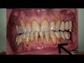 Correct Gum Recession With AMAZING Results - The Pinhole Technique