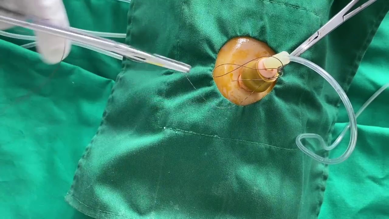 Pemasangan Akses Vena Umbilical Pada Neonatus