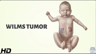 Wilms' Tumor: Everything You Need To Know