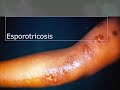 Esporotricosis y cromobiastomicosis   micologia
