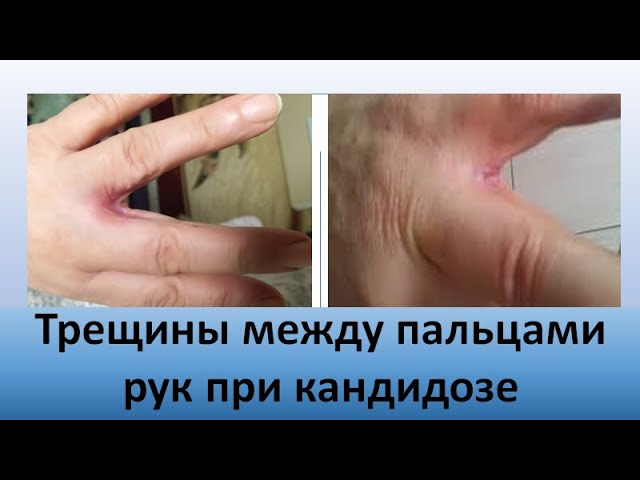 Почему развивается грибок кожи рук – причины