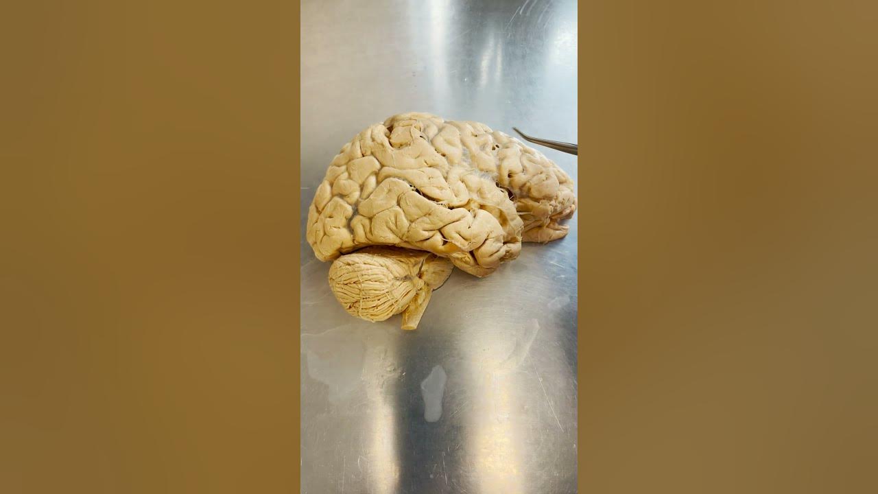 Alzheimers vs dementia youtube